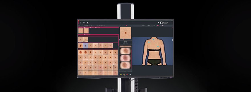 Wideodermatoskopia jako podstawowe narzędzie w diagnostyce czerniaka.