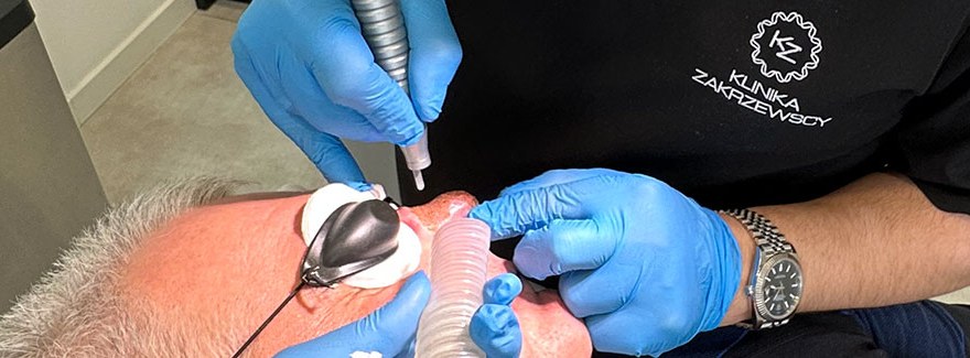 Laseroterapia w leczeniu rhinophymy, czyli guzowatości nosa