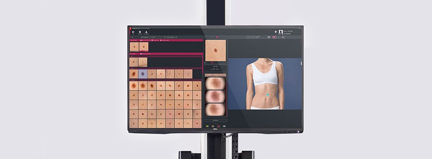 Wideodermatoskopowe badanie znamion – poradnik dla Pacjenta