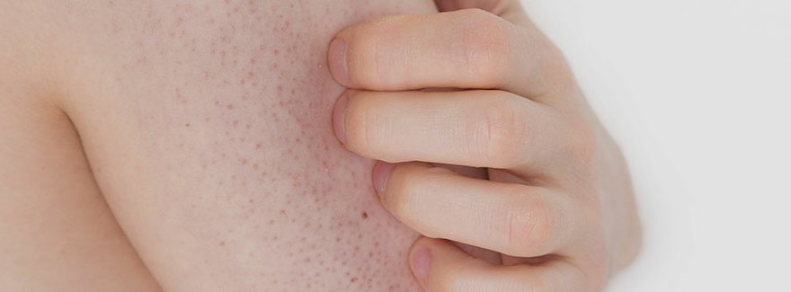 Keratosis pilaris, czyli rogowacenie mieszkowe – przyczyny, leczenie, zapobieganie