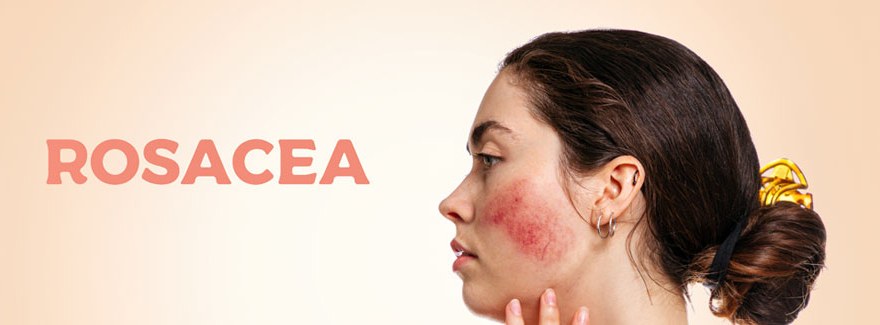 Dokucza ci zaczerwienienie twarzy? Poznaj najnowsze sposoby leczenia rumienia w trądziku różowatym.