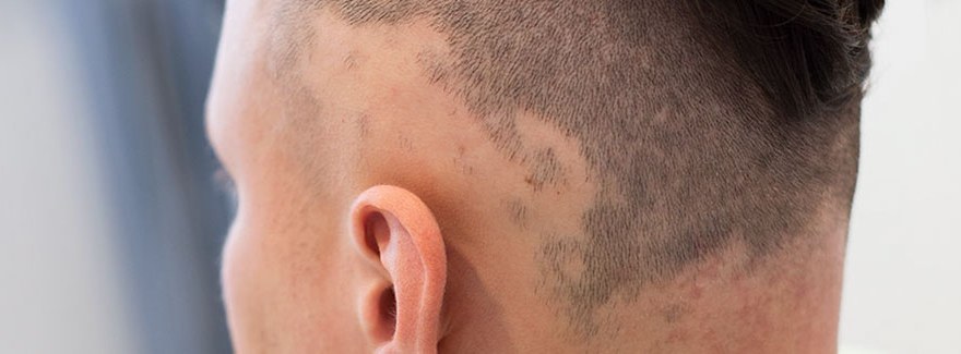 Objawy, które pomagają rozpoznać łysienie plackowate podczas trichoskopii 