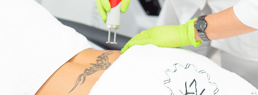 Jak usunąć tatuaż? Wszystko, co musisz wiedzieć na ten temat.