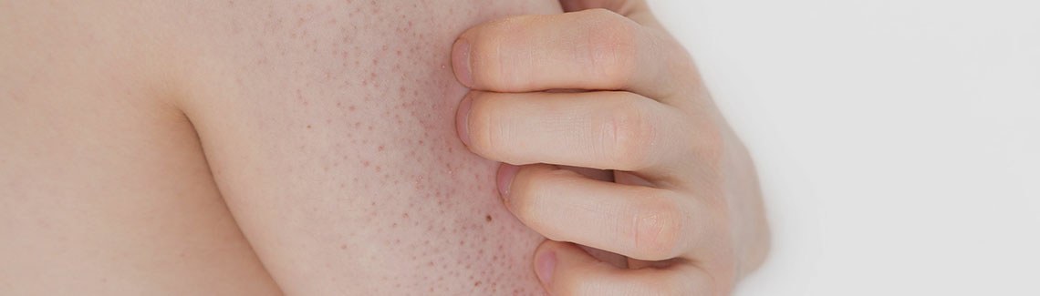 Keratosis pilaris, czyli rogowacenie mieszkowe – przyczyny, leczenie, zapobieganie