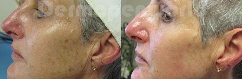 Dermapen 4.0
