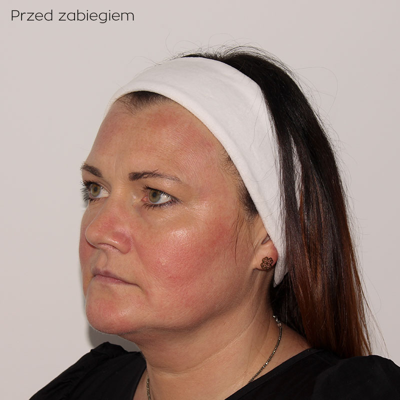 efekty zabiegu wolumetrii twarzy w klinice zakrzewscy