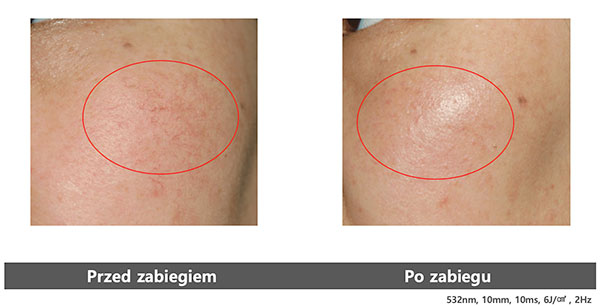 v laser