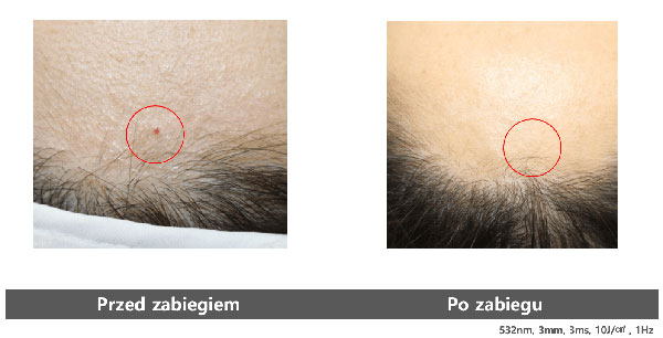 v laser katowice